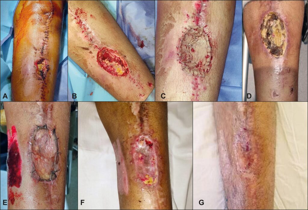 Necrosis tras Abdominoplastia: Riesgos y Prevención