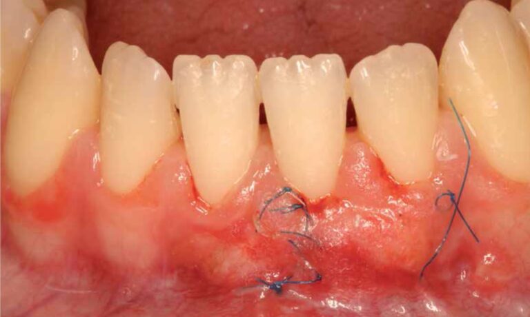 Costo de la Cirugía Plástica Periodontal