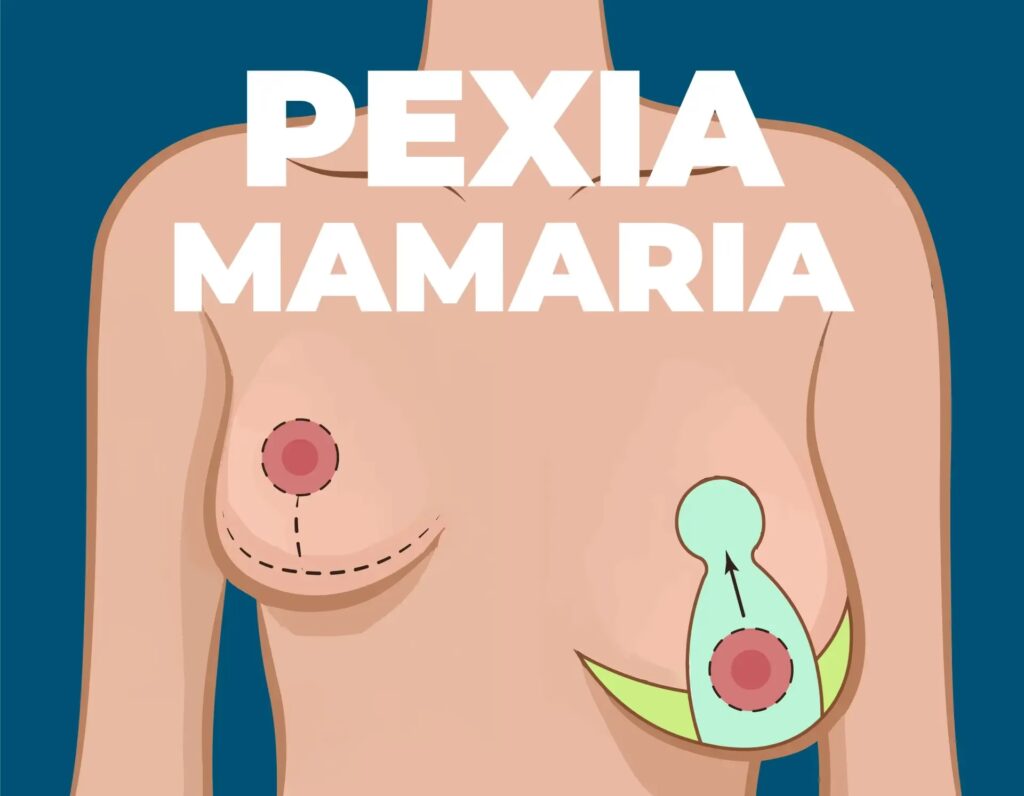 Mastopexia: Todo sobre el Levantamiento de Senos