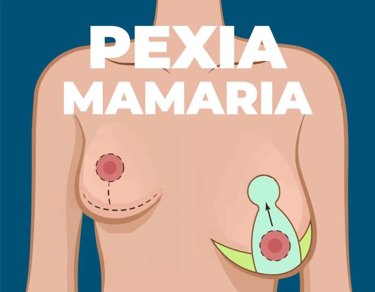 Mastopexia: Todo sobre el Levantamiento de Senos