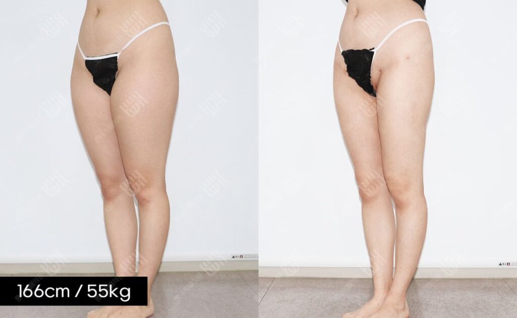 Tu Vientre Plano: Abdominoplastia en Corea del Sur