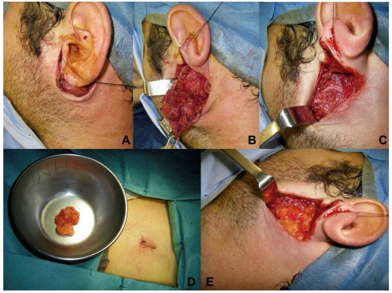 Recuperación de la Cirugía de Parótida: Guía