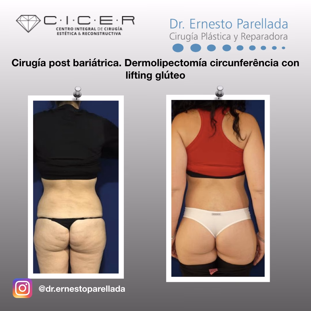 ¿Costo de cirugía bariátrica en Argentina?