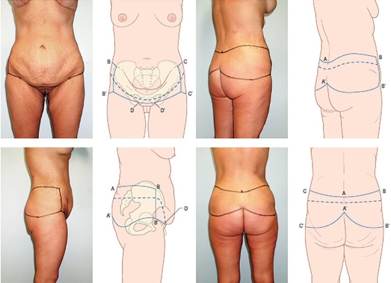 Abdominoplastia Post Bariátrica: ¿El Momento Ideal?