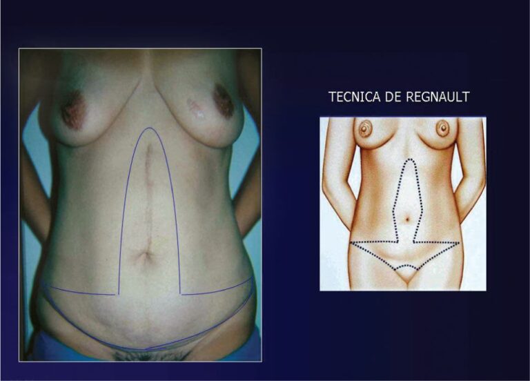 Costo de la Cirugía Bariátrica en Chile: Guía 2024