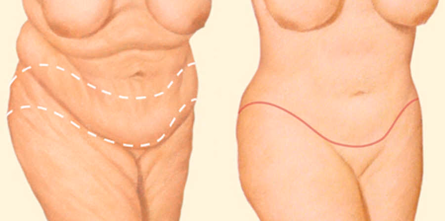 ¿Cuánto vale una cirugía bariátrica en Chile?