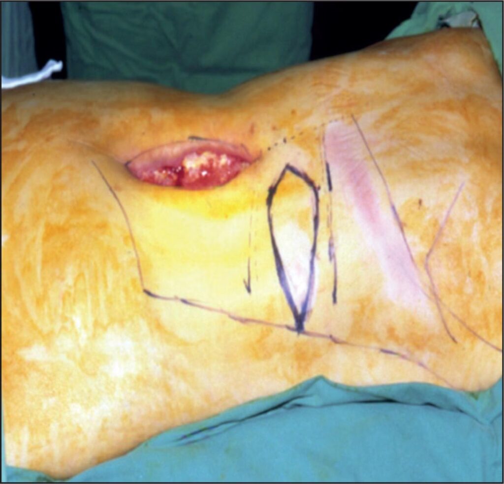 Cirugía Plástica Oncológica: Recuperando Formas