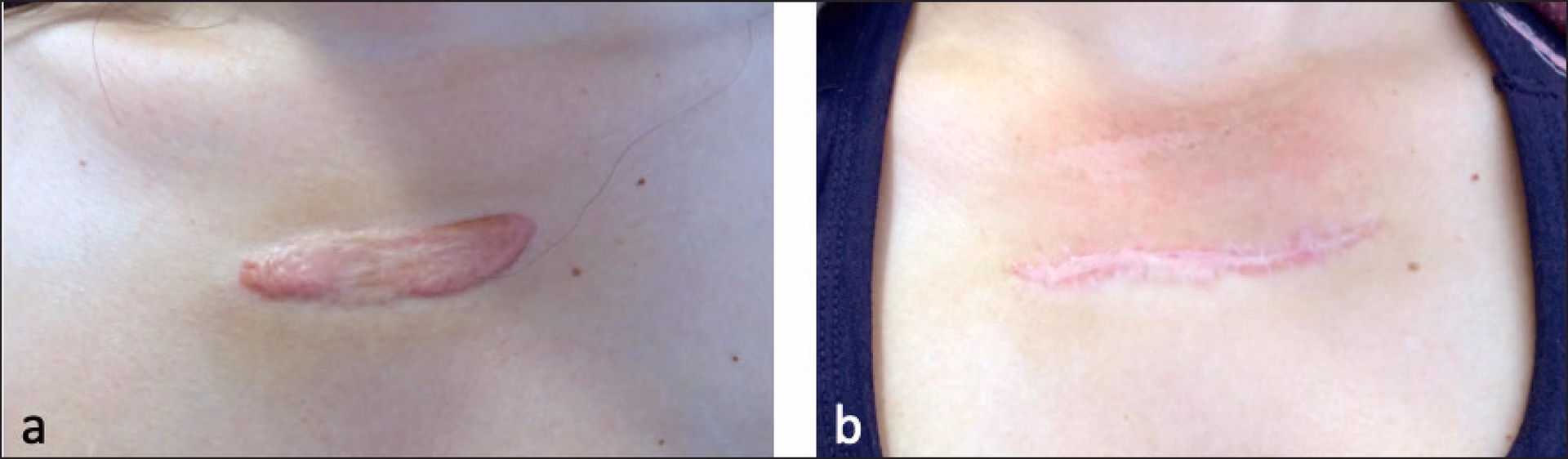 ¿Qué es la cirugía plástica oncológica?