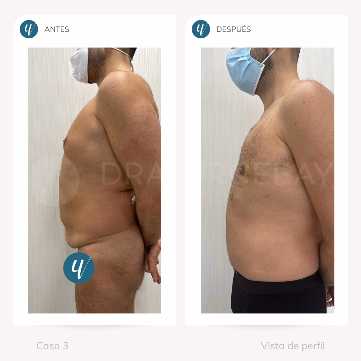 ¿Qué ocurre 10 años después de una cirugía de manga gástrica?