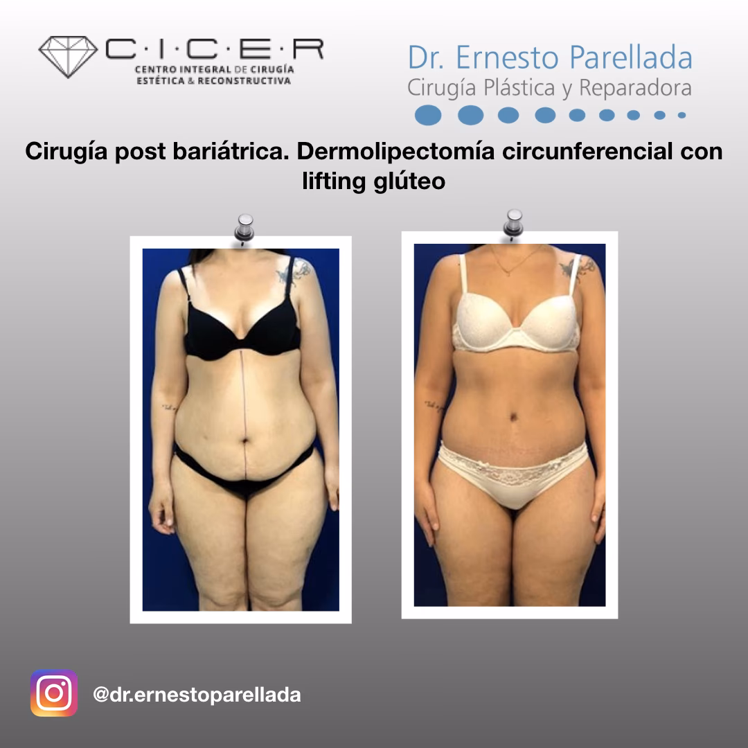 ¿Qué es la cirugía postbariatrica?