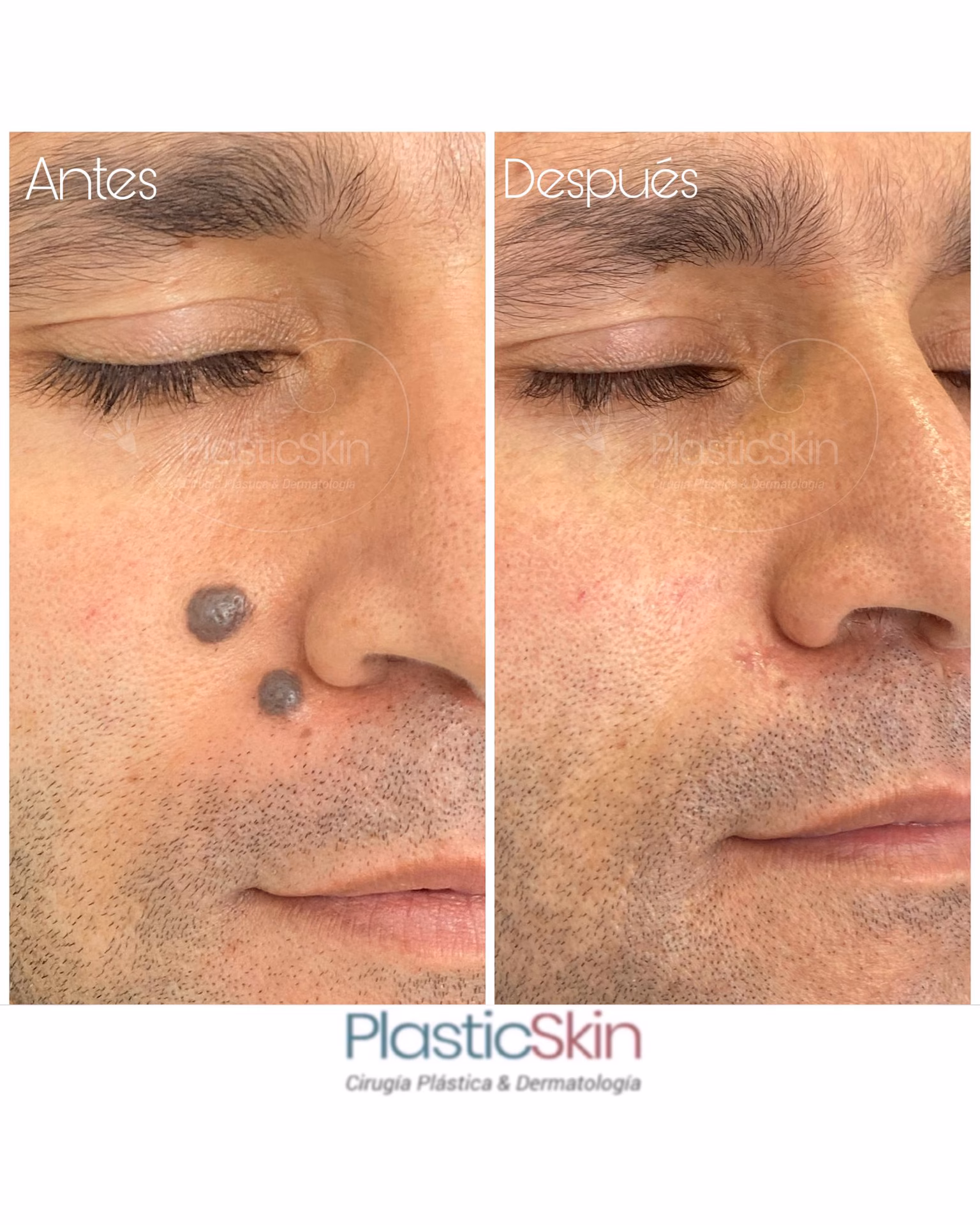 ¿Cómo se llama la cirugía para quitar lunares?