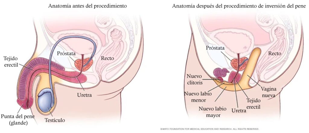 Cirugía de Reafirmación de Género: Costos y Vías