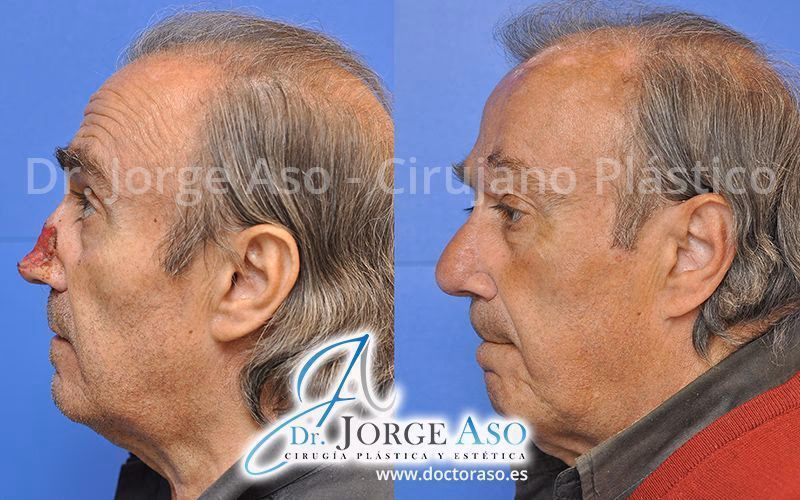 ¿Qué es la cirugía de reconstrucción nasal?