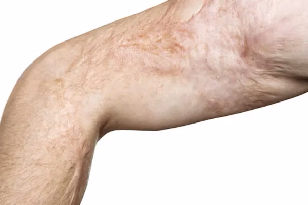 ¿Qué es la cirugía plástica reconstructiva en quemaduras?