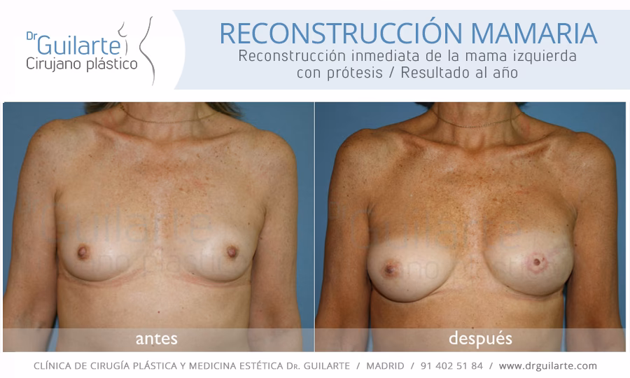 ¿Cuánto cuesta una cirugía reconstructiva de seno?