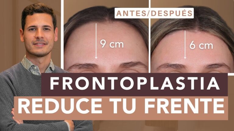 Frontoplastia: La Cirugía para Reducir la Frente