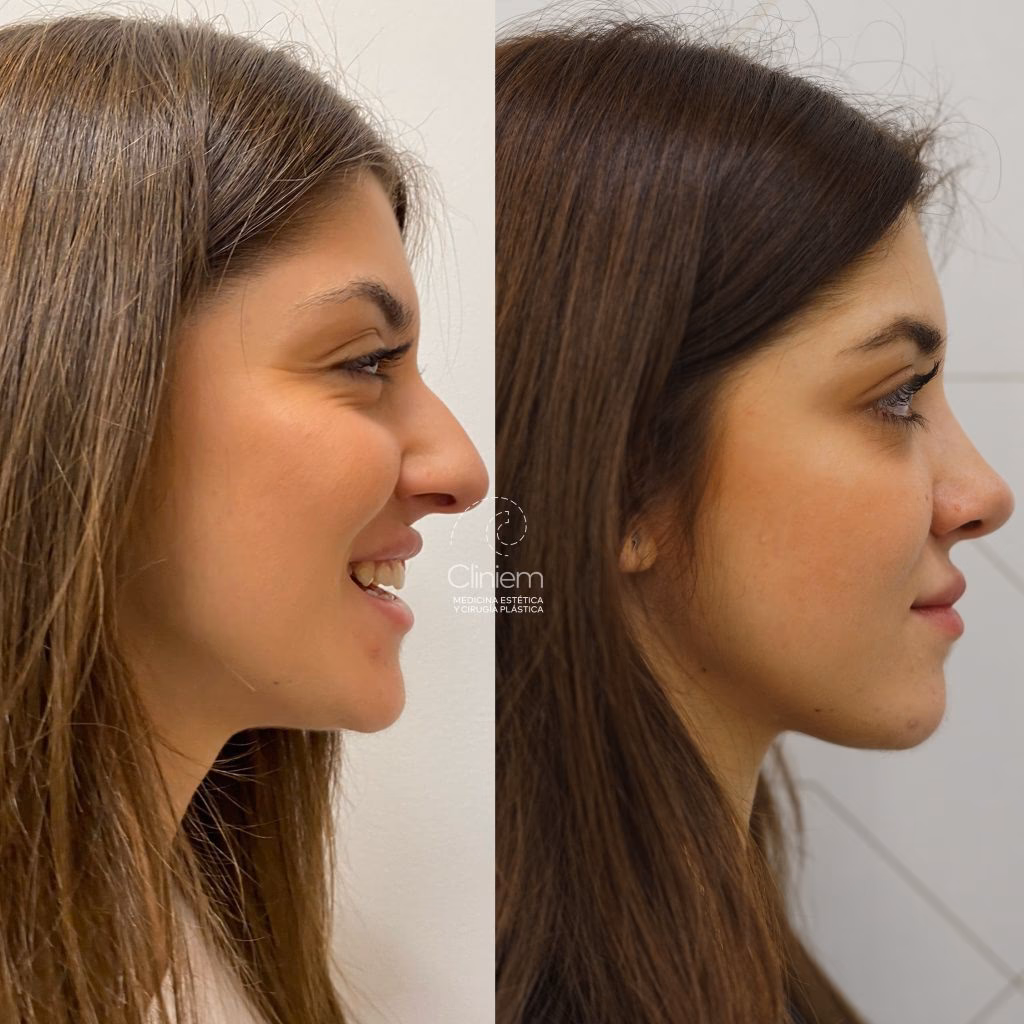 ¿Cuánto cuesta una cirugía para reducir la nariz?