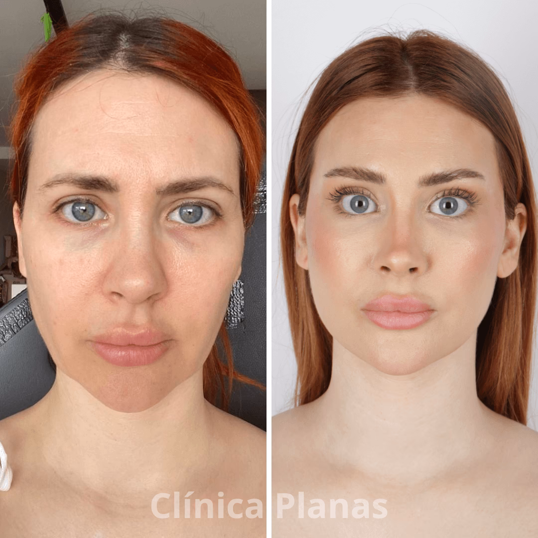 ¿Qué es lo más nuevo para rejuvenecer el rostro?