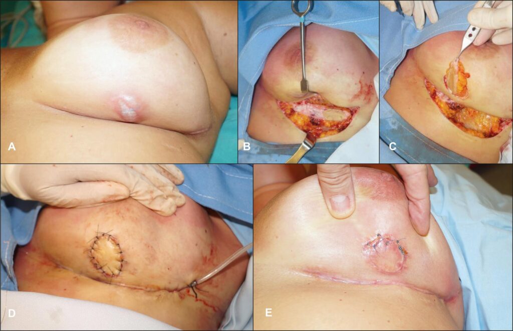 Cirugía de Colgajos Cutáneos Anales: Tu Guía
