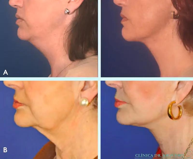 ¿Cuánto dura la recuperación de una cirugía de cuello?