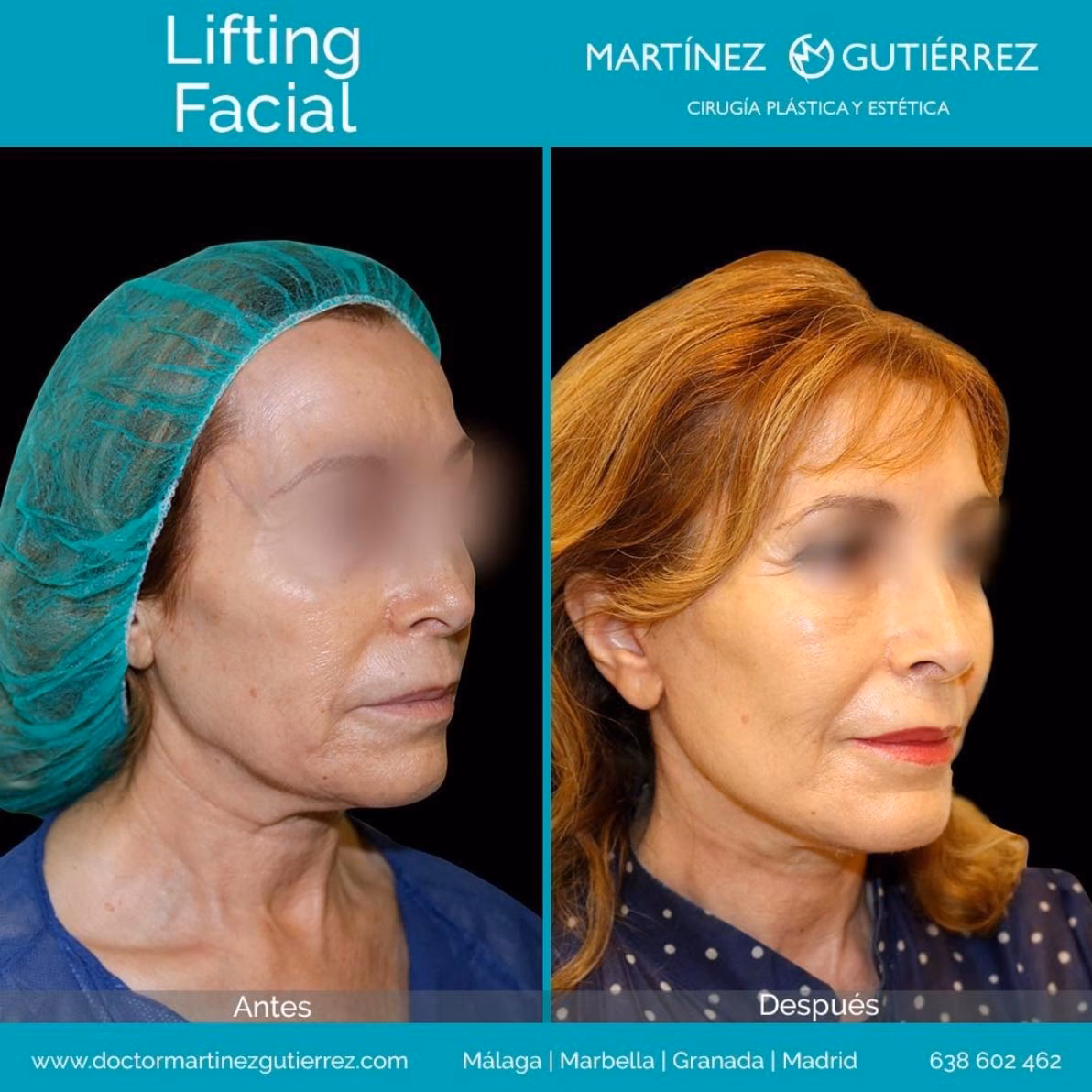 ¿Qué tan riesgosa es una operación de cuello?