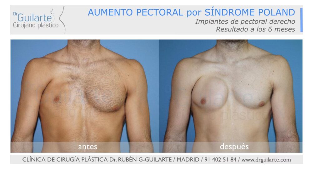 Síndrome de Poland: Opciones de Corrección Quirúrgica