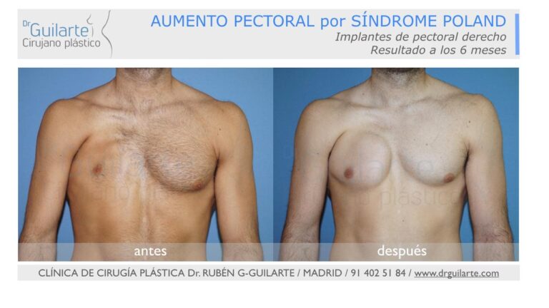 Síndrome de Poland: Opciones de Corrección Quirúrgica