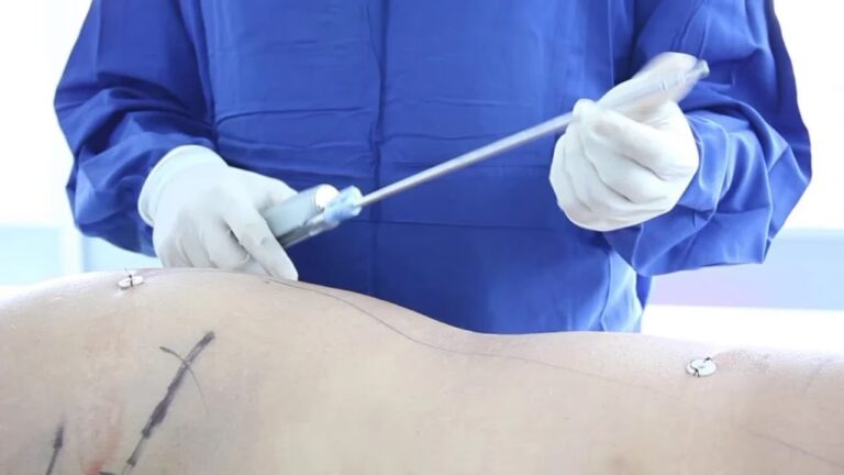 Cirugías Plásticas con Anestesia Local: Guía Completa