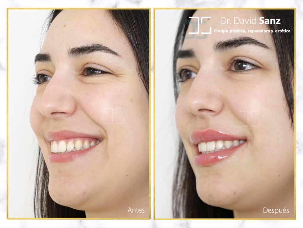 Costo de la Cirugía de Sonrisa: Guía Completa