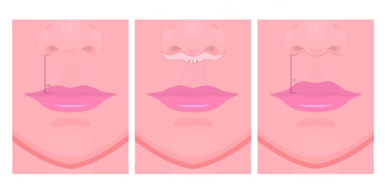 Lifting de Labios: La Guía Definitiva