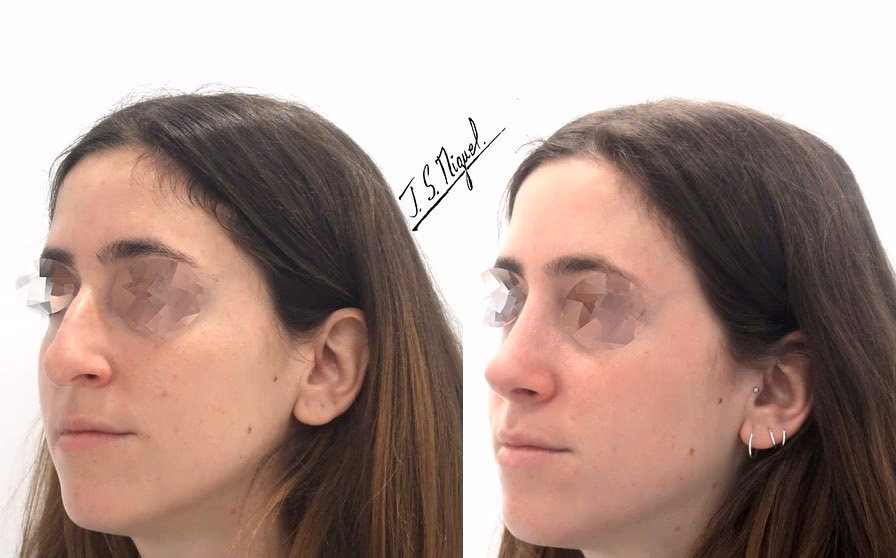 ¿Cuánto cuesta una cirugía para corregir un tabique desviado?