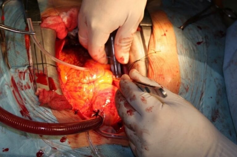 Cirugía de Válvula Mitral: Técnicas y Recuperación