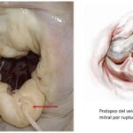 Cirugía de Válvula Mitral: ¿Cuándo es necesaria?