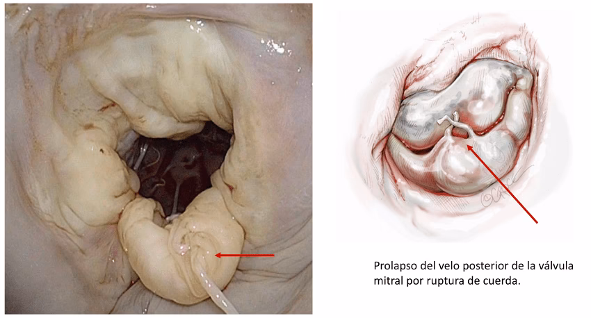 ¿Cuál es la nueva técnica para el reemplazo de la válvula mitral?