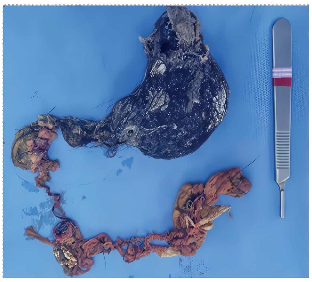 Cabello de Rapunzel: El Secreto en la Cirugía