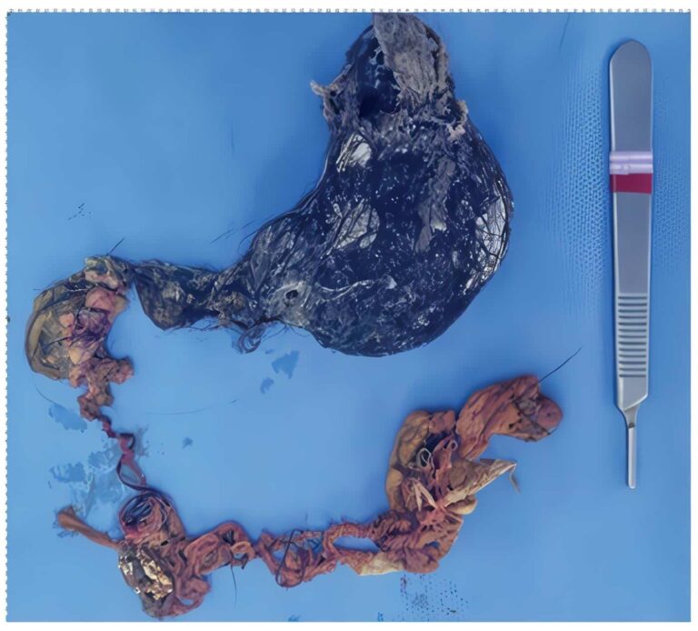 Cabello de Rapunzel: El Secreto en la Cirugía