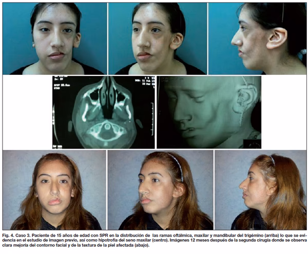 ¿Qué es la hemiatrofia facial?