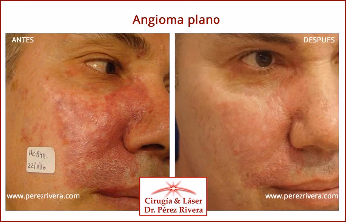 ¿Se considera la extirpación de un hemangioma un procedimiento estético?