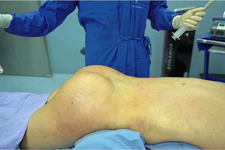 Cirugía de Glúteos con Grasa: Guía Completa