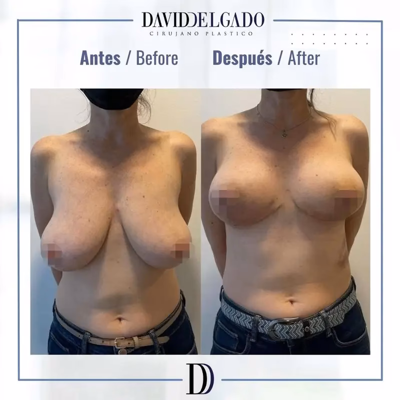 ¿Cómo se llama el levantamiento de senos sin implantes?