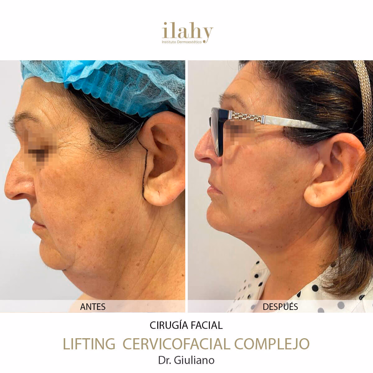 ¿Cómo se llama la cirugía de recorte de piel en la cara?