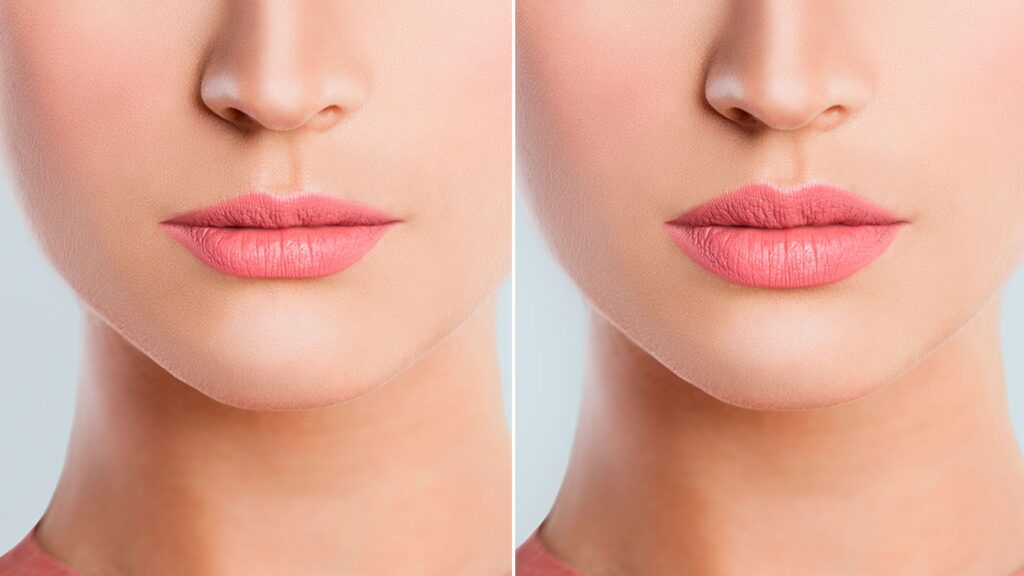 Aumento de Labios: Guía de Procedimientos