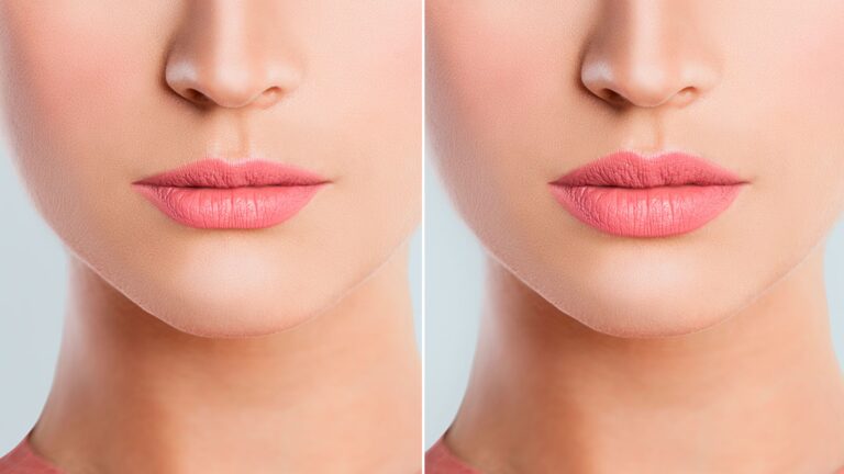 Aumento de Labios: Guía de Procedimientos