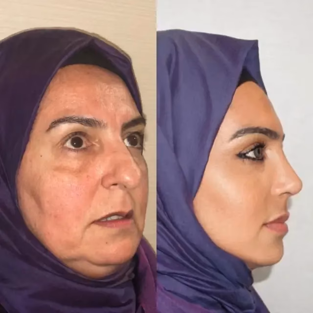 ¿Cuál es la cirugía estética más popular en Turquía?