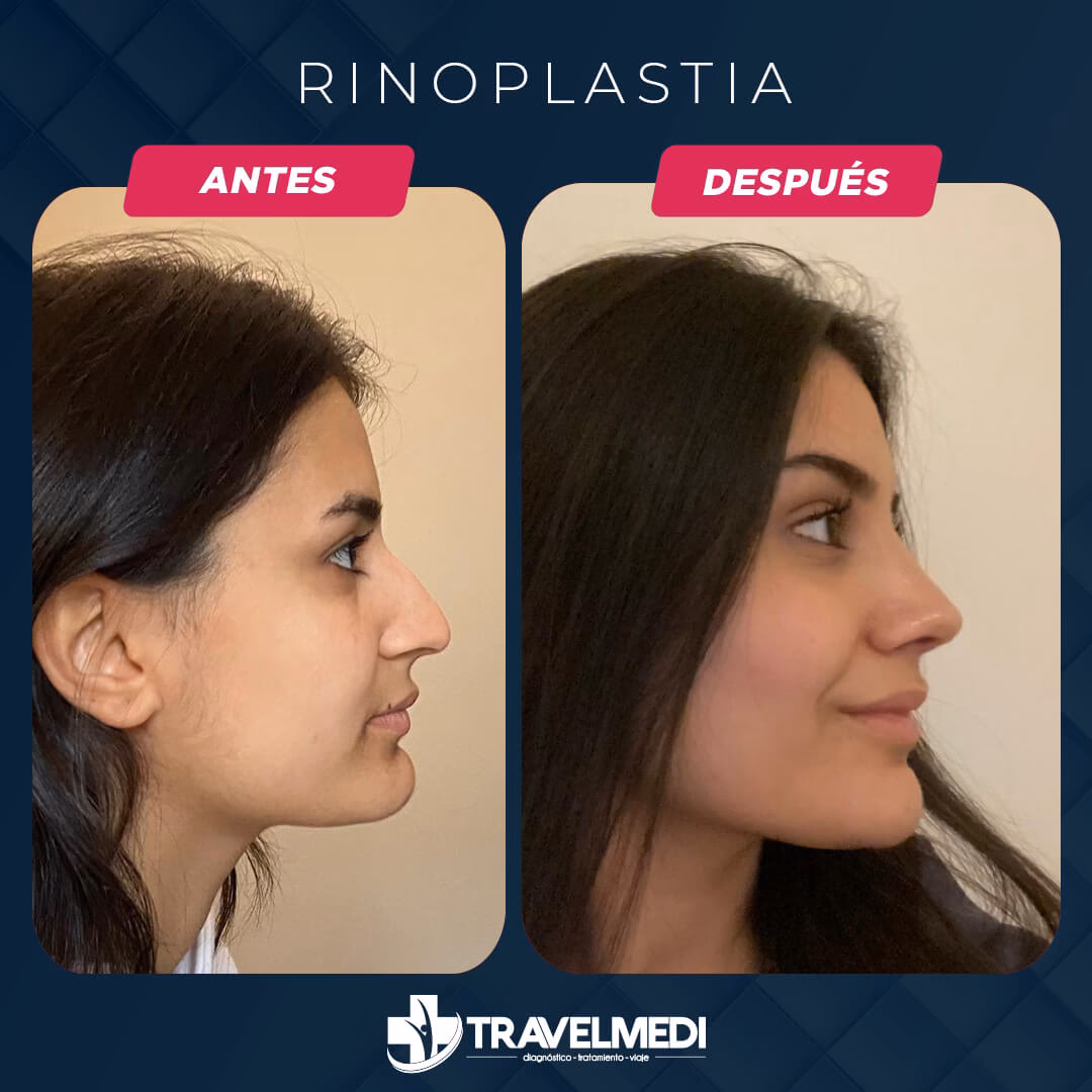 ¿Cuál es la cirugía estética más popular en Turquía?