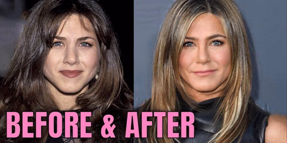 ¿Qué cicatrices tiene Jennifer Aniston en la cara?