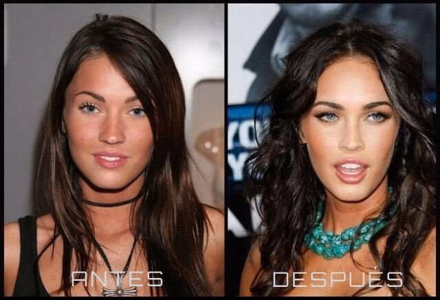 ¿Cómo se ve una abdominoplastia mal hecha?