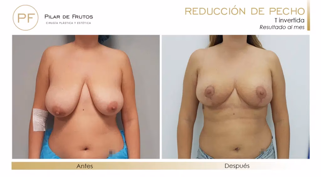 ¿Cómo corregir una reducción de pecho mal realizada?