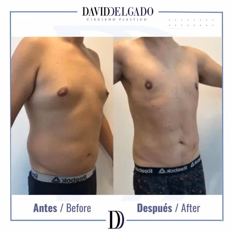 ¿Qué cirugías estéticas existen para hombres?