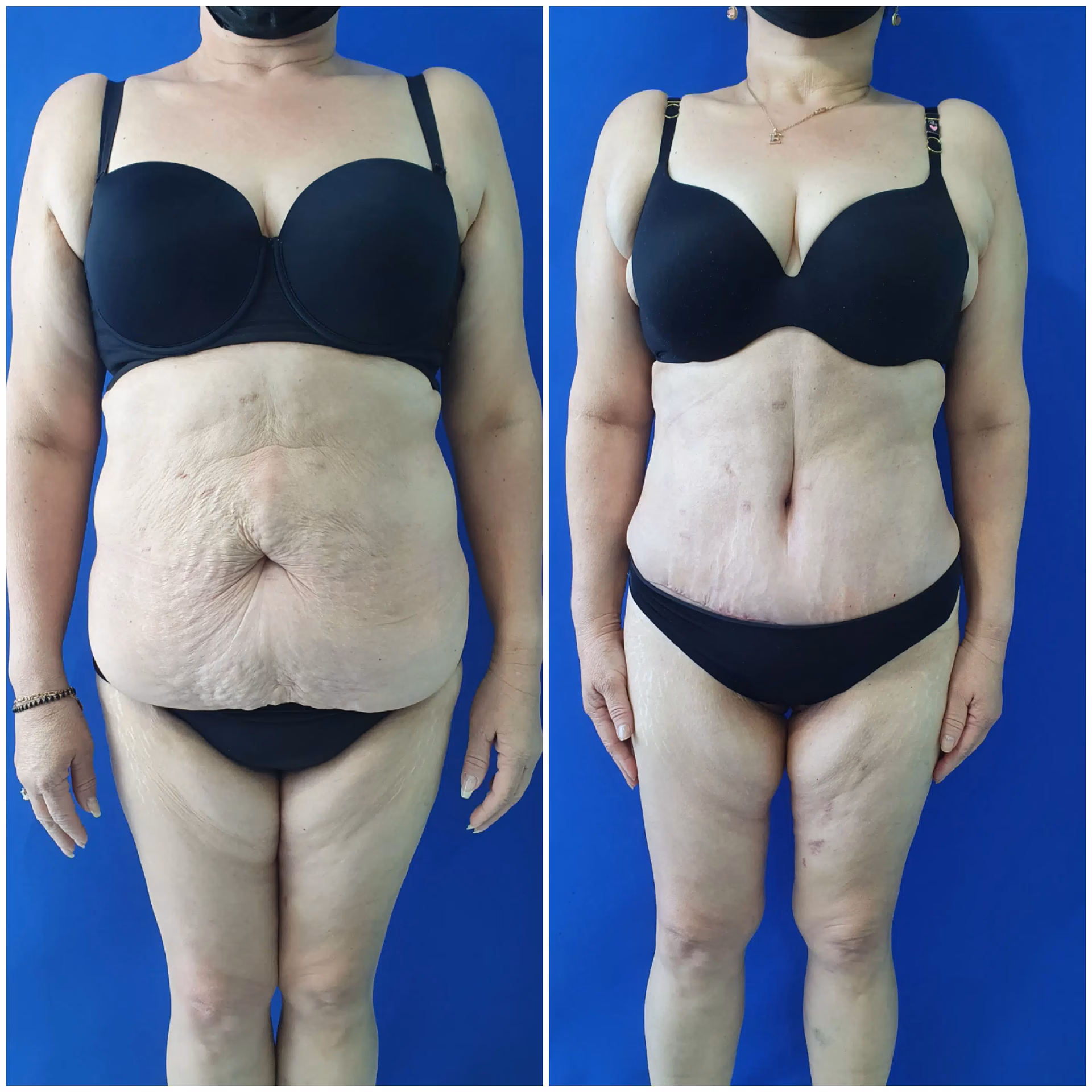 ¿La cirugía bariátrica es una cirugía estética?